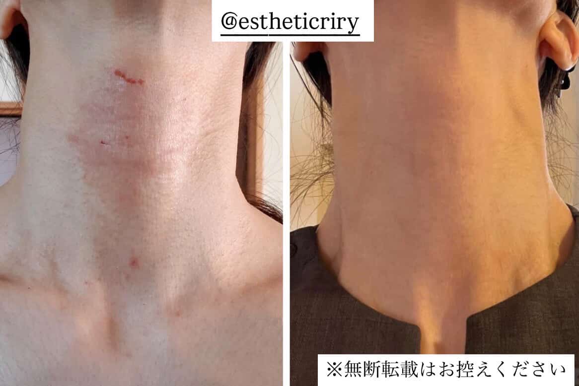 首元のビフォーアフター